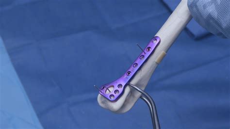 Arthrex Ortholine Distal Humeral Fracture System Sawbone