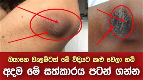 ඔයාගෙ වැලමිටත් මේ විදියට කළු වෙලා නම් අදම මේ සත්කාරය පටන් ගන්න Dark Elbows Treatment In