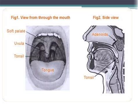 Diseases Of Tonsils And Adenoids Ppt