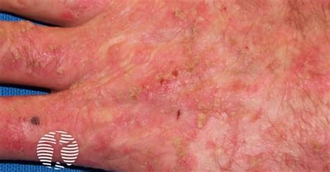 Dermnet Actinic Keratoses Image