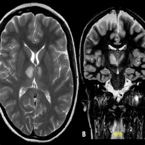 A Axial Sections T2 Weighted Mri Show Hyperintense Lesions In Download Scientific Diagram