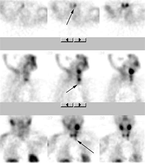 Radionuclide Imaging Of The Parathyroid Glands Patterns Pearls And