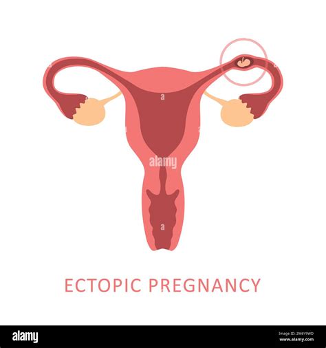 embarazo ectópico femenino sistema reproductivo mujeres útero Imagen