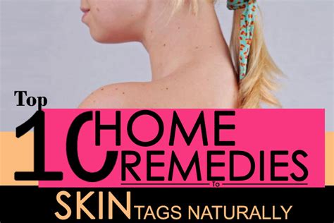 Top 10 Home Remedies to Remove Skin Tags Naturally