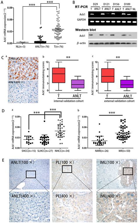 Ack1 Expression Is Significantly Increased In Hcc And Correlated With