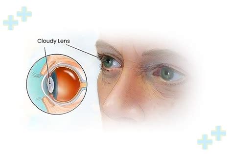 Femto Laser Assisted Cataract Surgery FLACS Health Trawell