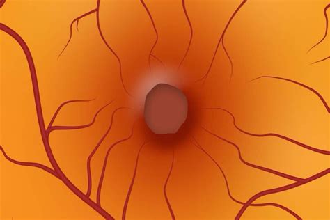 Agujero Macular En Ojopedia