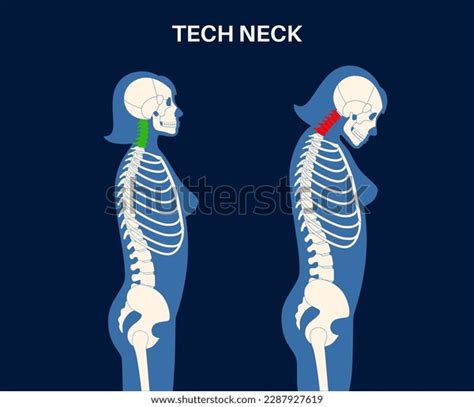 Diagram Deformation Cervical Vertebrae Neck Spasm Stock Vector (Royalty ...