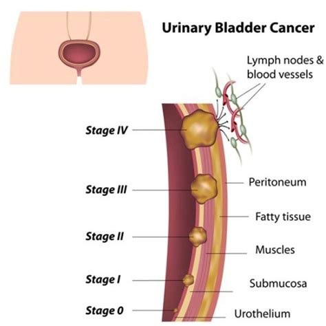 Bladder Cancer Symptoms And Causes Artofit