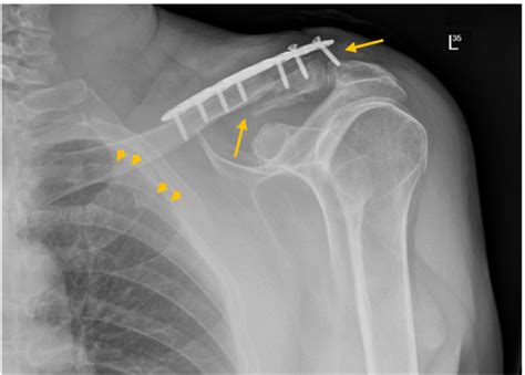 X Ray Plain Film Of The Chest Showing The Left Clavicle Fixation