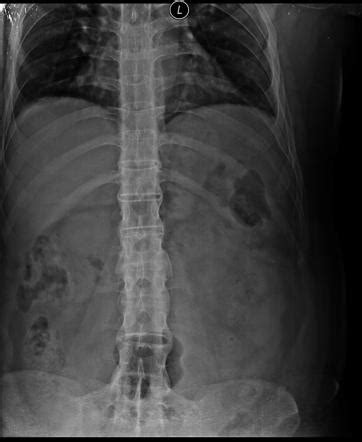 Bamboo spine (ankylosing spondylitis) | Radiology Reference Article ...