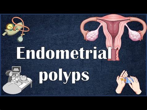 Endometrial Uterine Polyps Everything You Need To Know Youtube