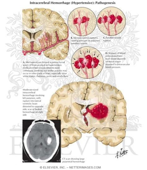 Intracerebral Hemorrhage Hypertensive Pathogenesis