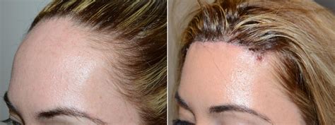 Forehead Reduction Surgery Photos Miami FL Patient58825