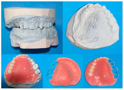 The Effect of Immediate Obturator Reconstruction after Radical