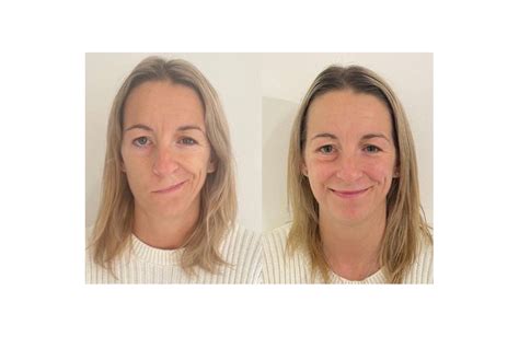 Caci Synergy Treatments Prove Successful In Treating Bells Palsy Client