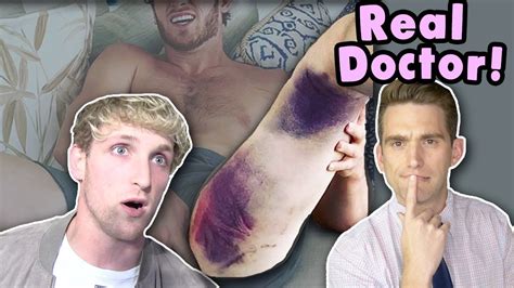 Doctor Explains Hamstring Bruise And Logan Paul Injury Real Or Fake