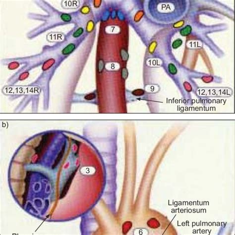 Lung Cancer Lymph Nodes