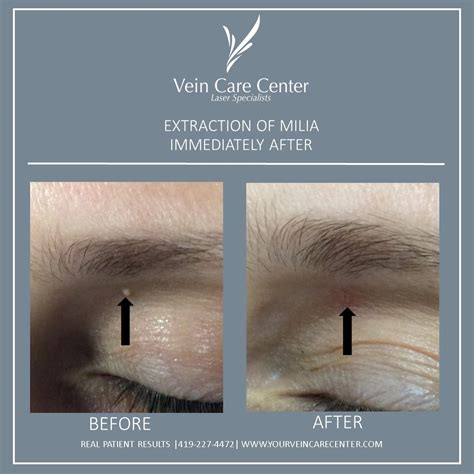 Extraction of Milia Before & After Lima, Ohio | Vein Care Center