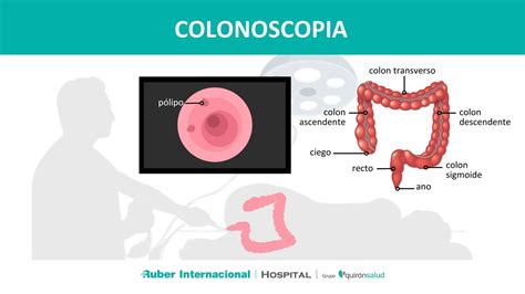 O Que A Colonoscopia Detecta - Colonoscopia: Clave en la detección precoz del cáncer colon