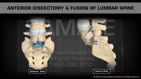 Anterior Discectomy And Fusion Of Lumbar Spine Youtube