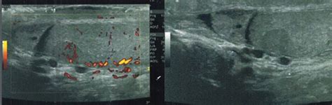 Scrotal Ultrasound Showing Hypervascular Hypoechogene Testicular Module