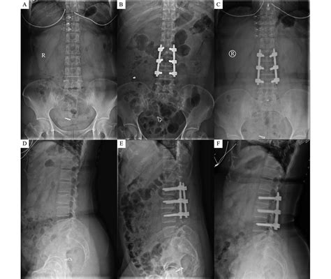 Preoperative Postoperative And Follow Up Radiographs Of The Patients