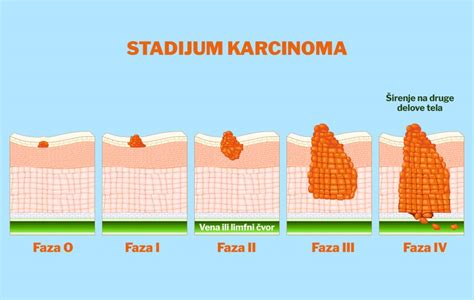 Stadijum Karcinoma Ta Nam Govori Faza U Kojoj Se Rak Nalazi Eklinika