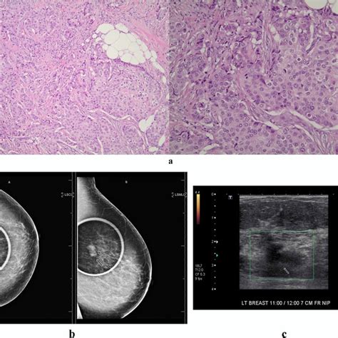 Pathological And Radiological Findings Of A Case Of Invasive Ductal