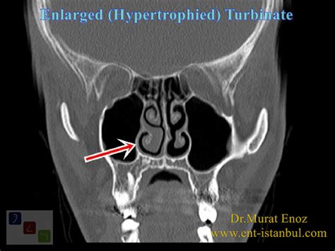 Turbinate Hypertrophy Definition Symptoms Causes And Treatment