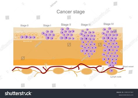 246 Tumor Grade Images, Stock Photos, 3D objects, & Vectors | Shutterstock