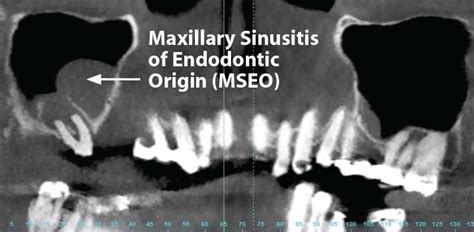 Can A Tooth Infection Cause Sinus Drainage Best Drain Photos Primagemorg