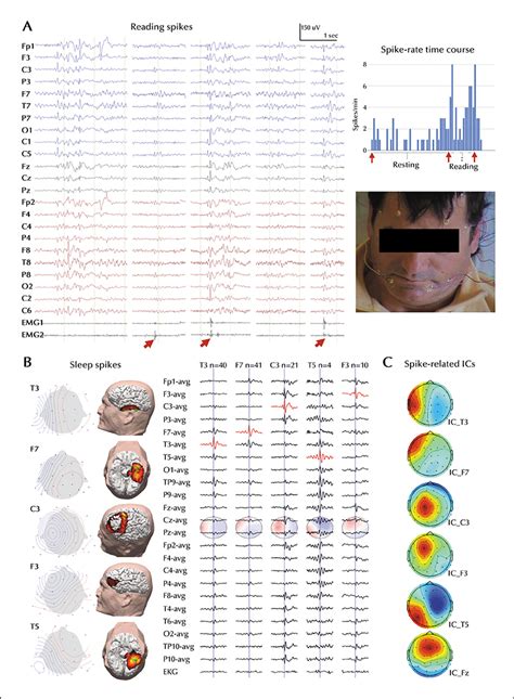 JLE Epileptic Disorders Visual Word Form Area Hyperexcitability