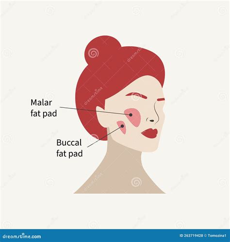 Removal of Malar Fat Pad and Buccal Fat Pad Stock Vector - Illustration