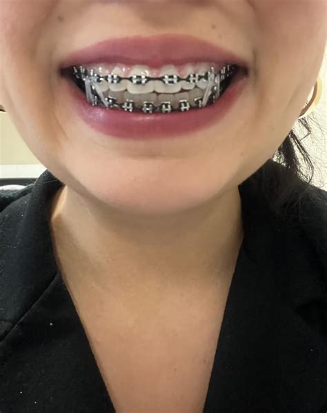 18 Month Update R Braces