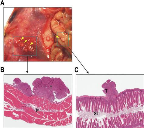 Histopathological Examination Of Tumors A Peritoneal Spread Of