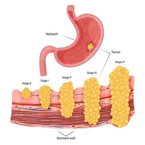 Stomach Cancer Stages Growth Malignant Cancerous Tumor Anatomical Vector Illustration Isolated