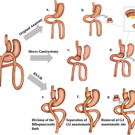 Roux En Y Gastric Bypass Diagram