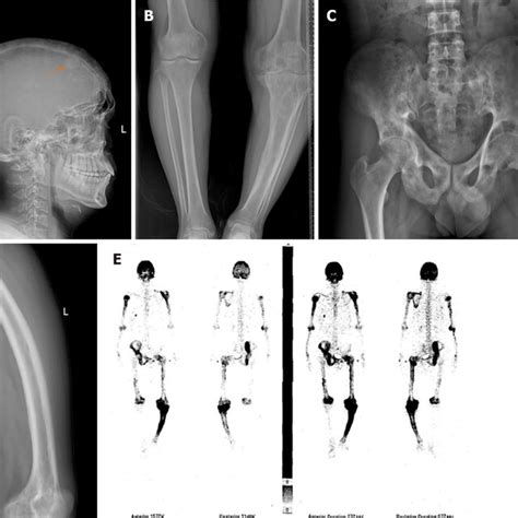 Imaging Changes In Patients With Paget S Disease Of Bone A Radiograph