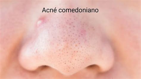 Dermatólogo Especialista En Acné Madriderma