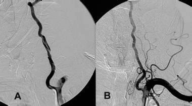 Vertebral Artery Dissection Mri