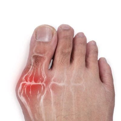 Bunions Hallux Abducto Valgus Foot Ankle Center Podiatrist