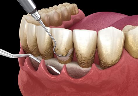 En qué consiste un curetaje Odas Clínica Dental