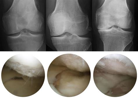 Melbourne Arthroplasty Knee Arthritis