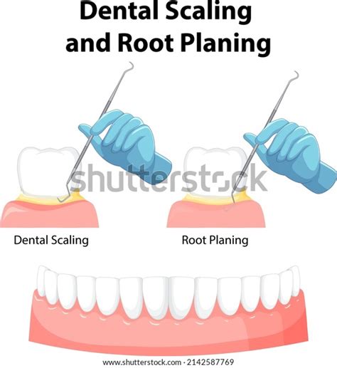 Infographic Human Dental Scaling Root Planing Stock Vector Royalty