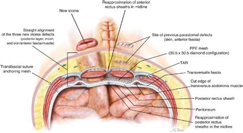 Open Retromuscular Keyhole Compared With Sugarbaker Mesh For Parastomal