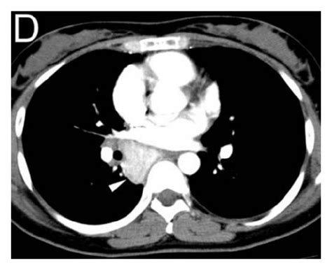 A Chest X Ray Image Showed A Mass Shadow In The Cardiac Silhouette