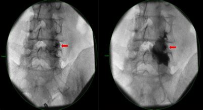 Improvement In Radicular Symptoms But Continued Facet Arthropathy And