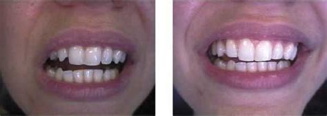 Bonding gaps between teeth with high end composite resins.