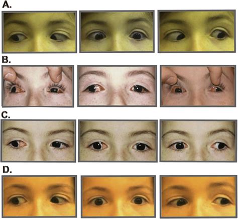 Case 1. (A) Parinaud syndrome, right esotropia and cerebral palsy. (B)... | Download Scientific ...